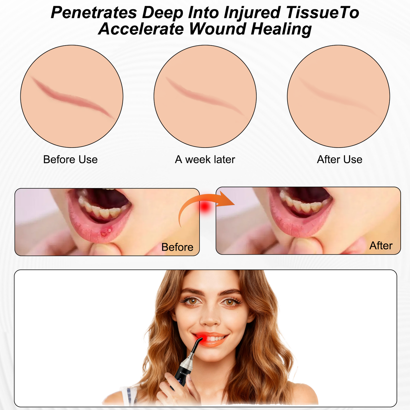 Fda Cleared ELVISH Cold Sore Treatment Device, Relieves Oral Ulcers, Nasal, Ear, Knee, Hand, Joint, Muscle & Nerve Pain, 460/630/660/850/900nm Wavelengths, Built-in Timer, 3 Flash Frequencies, 4 Home Modes, Teacher & Father'S Day Appreciation Gifts